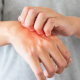 Eczema and Constipation