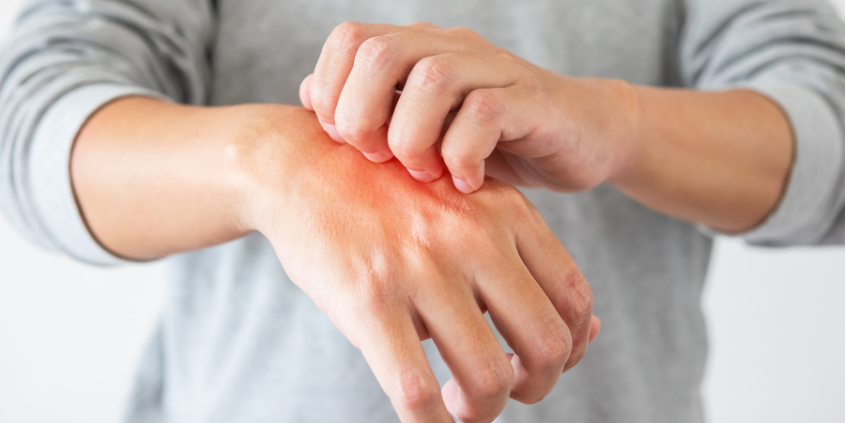 Eczema and Constipation